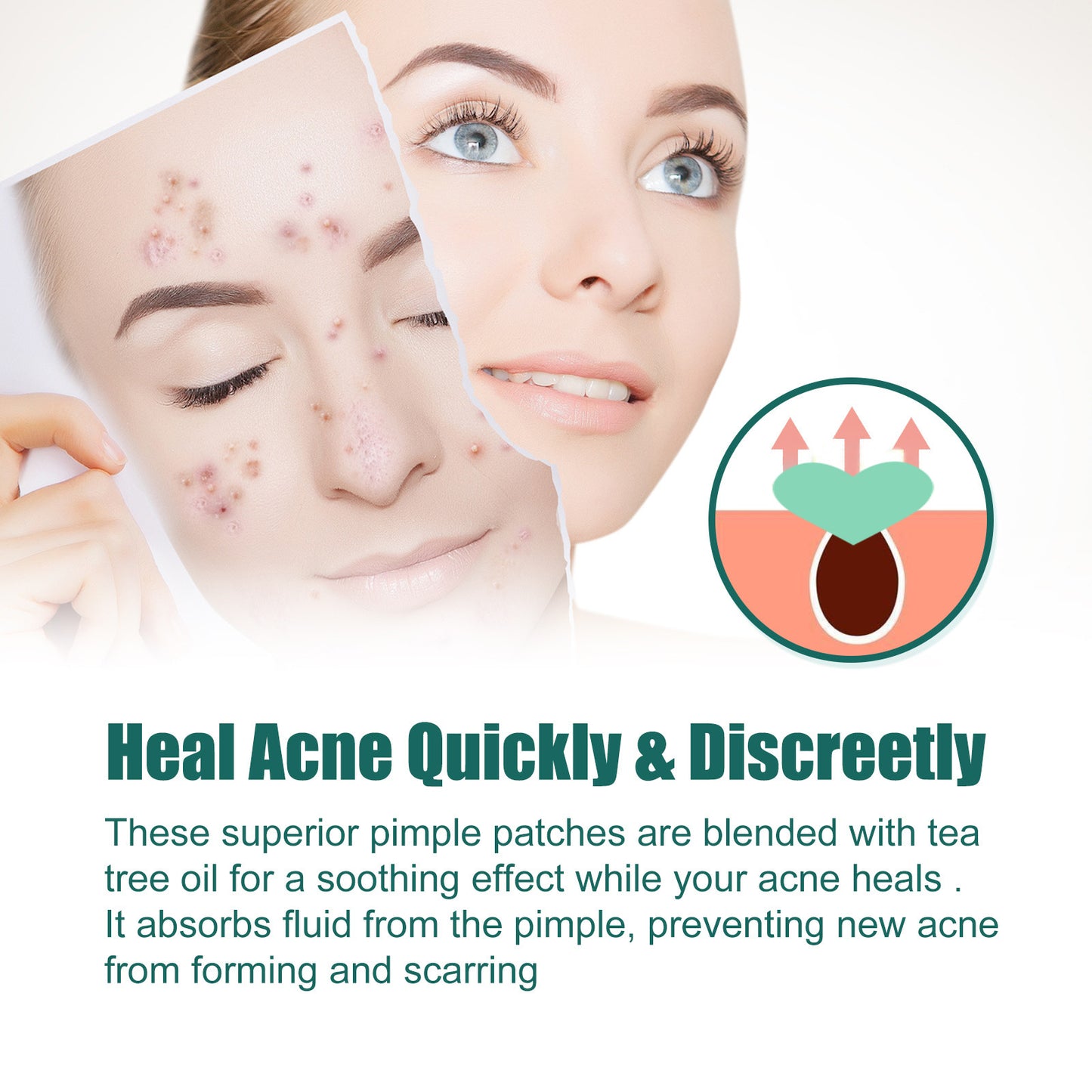 Love Acne Patch Gentle Cleansing Acne Patch- Fades Facial Acne Marks