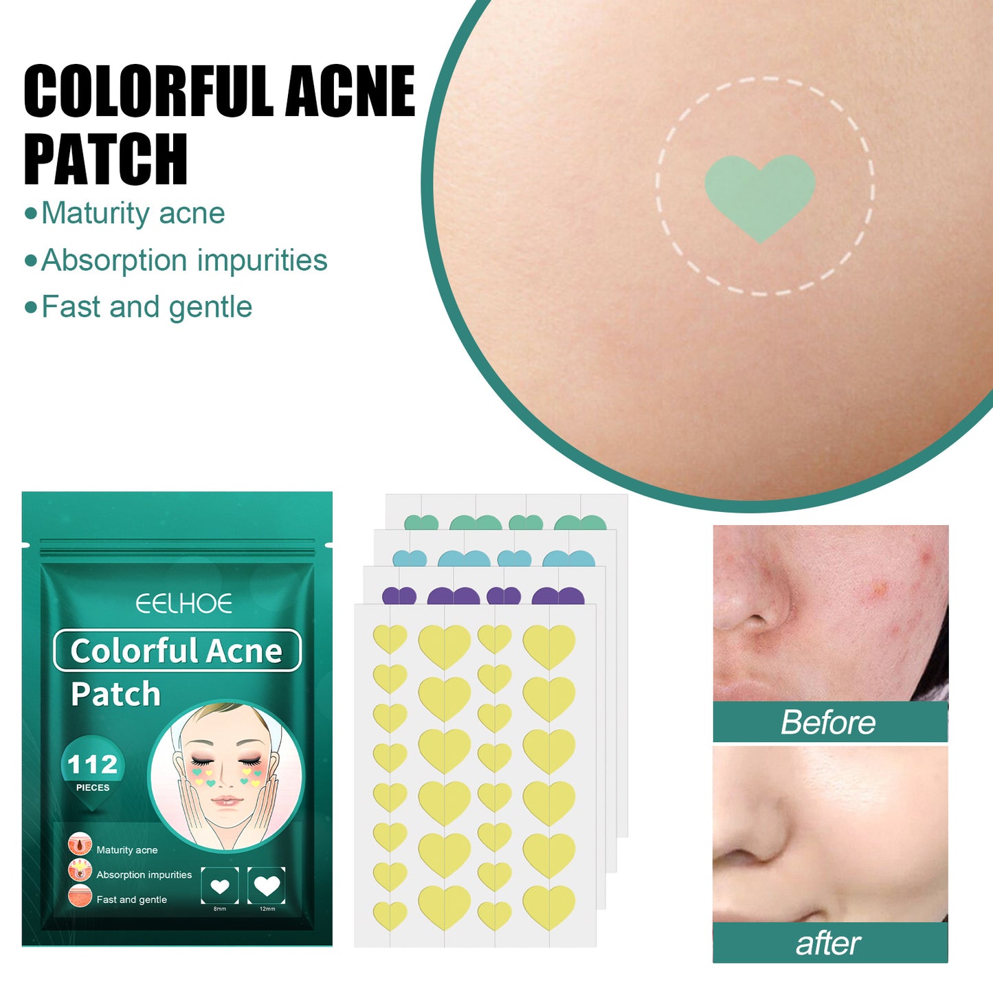 Love Acne Patch Gentle Cleansing Acne Patch- Fades Facial Acne Marks