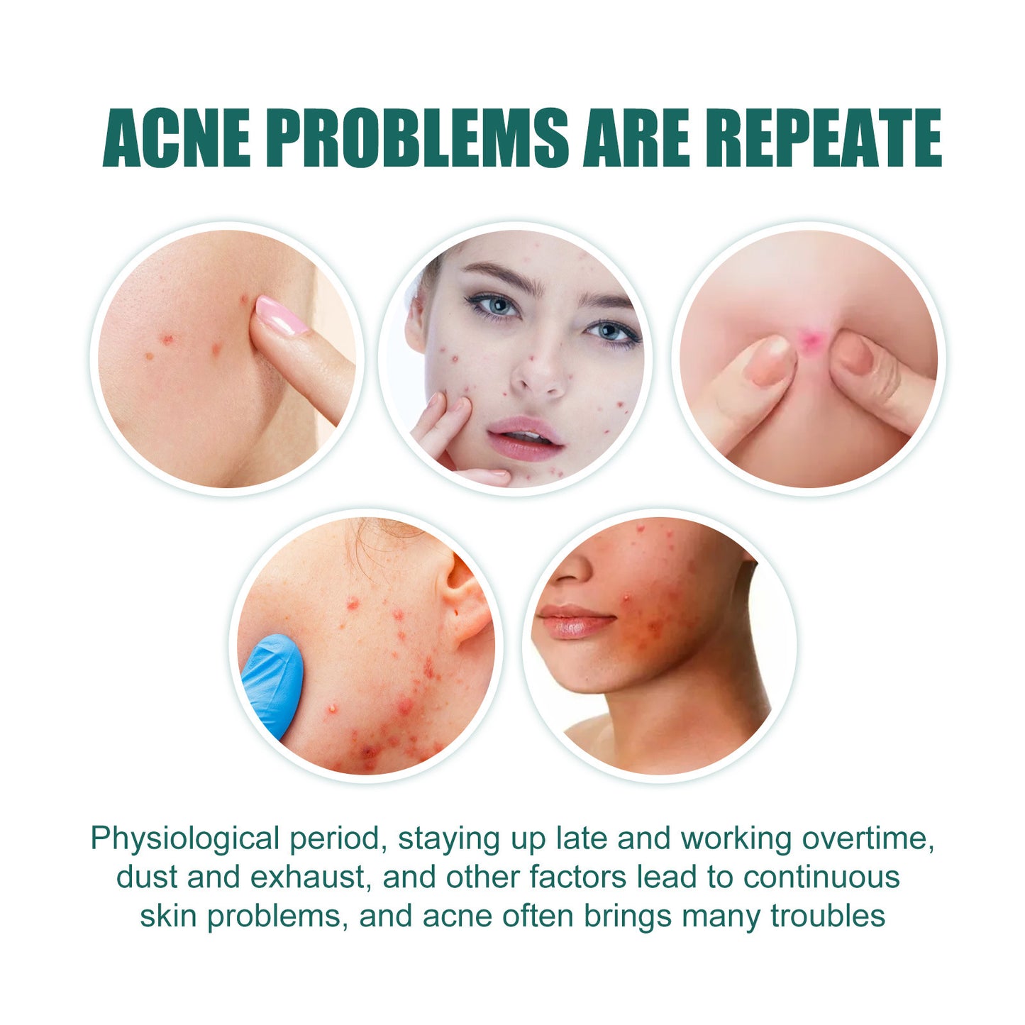 Love Acne Patch Gentle Cleansing Acne Patch- Fades Facial Acne Marks